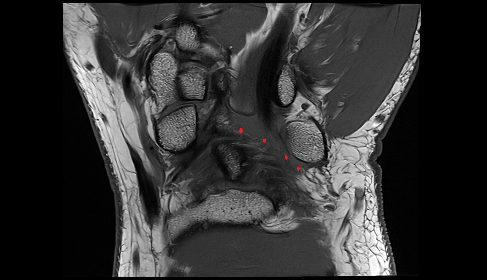 Ulnocapitate ligament mri coronal image