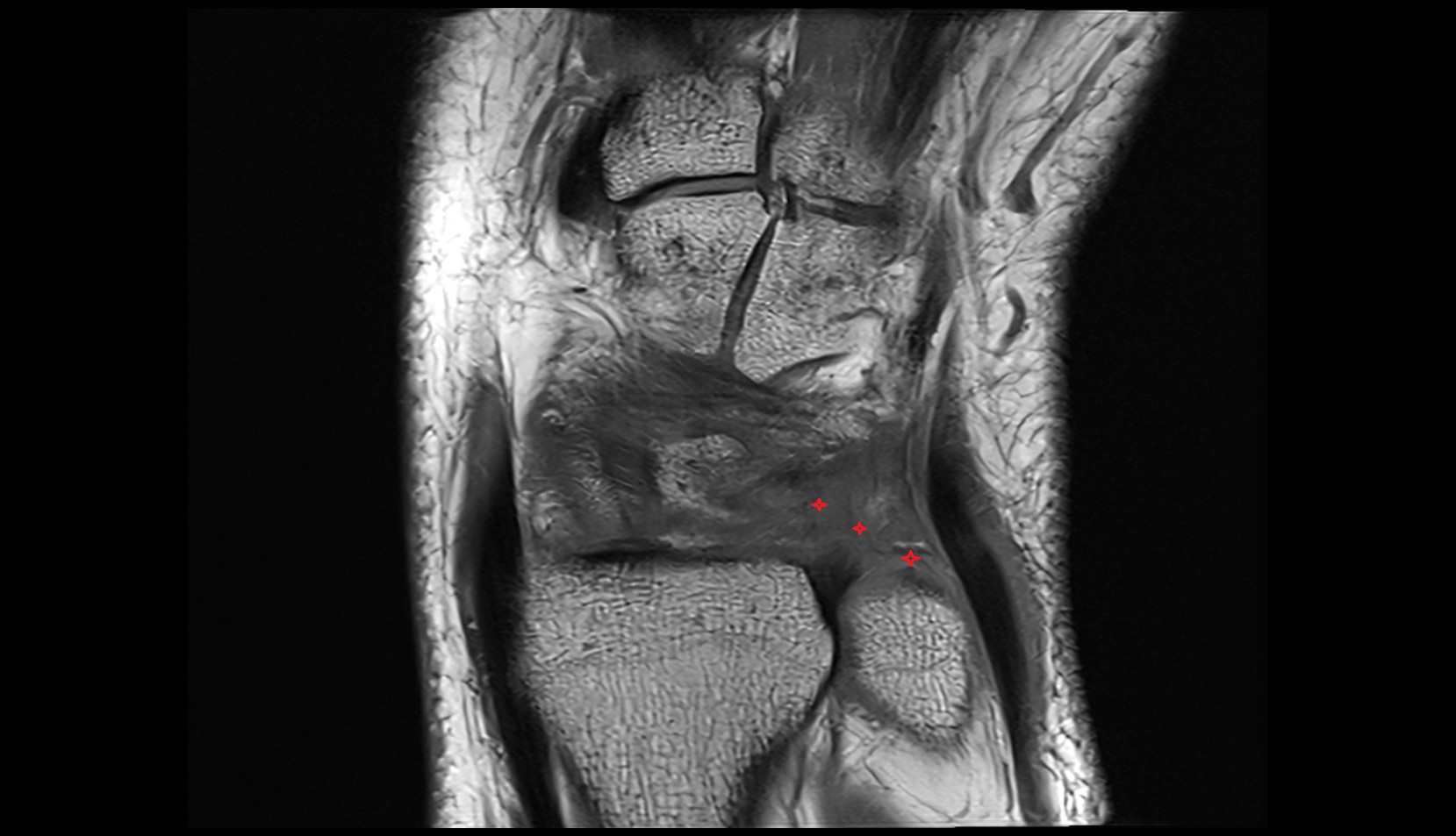 Ulnocarpal ligaments dorsal mri image