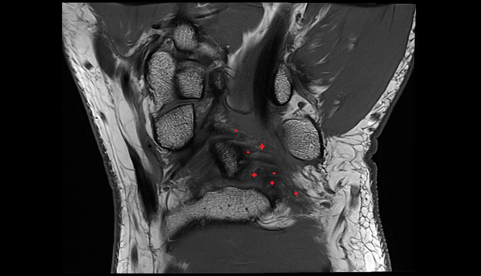 Ulnocarpal ligaments palmar