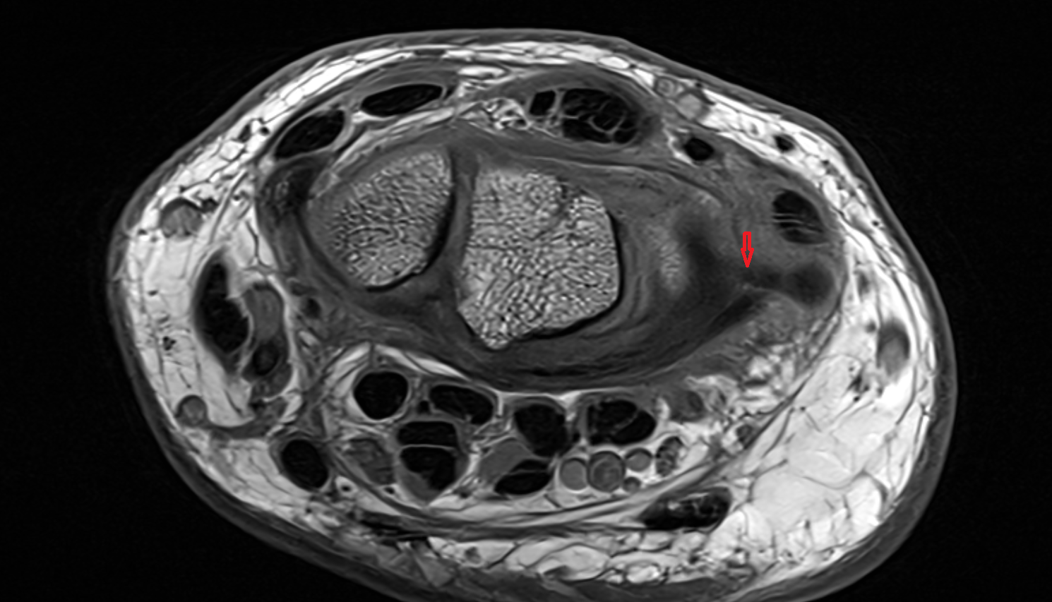 Ulnotriquetral ligament  axial cross sectional anatomy 3T MRI AI enhanced radiology image-img-00000-00000