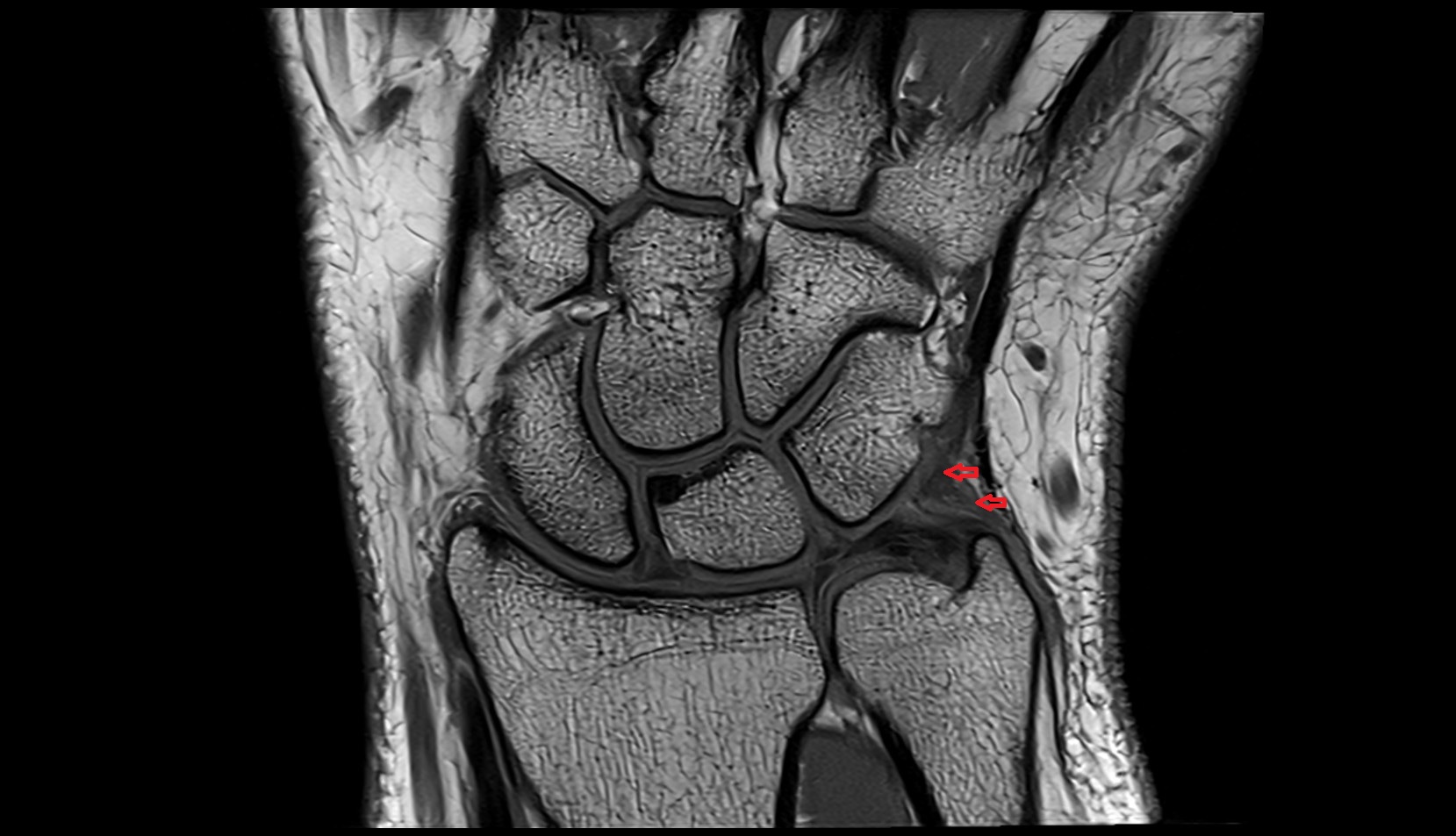 Ulnotriquetral ligament mri coronal image