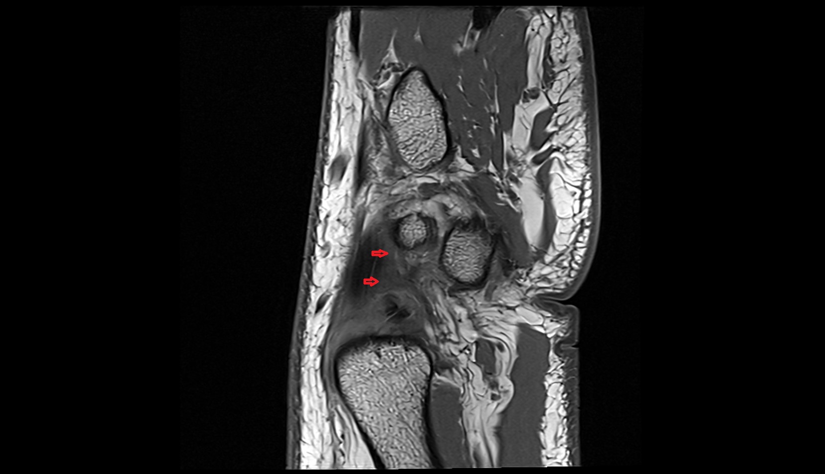 Ulnotriquetral ligament mri sag image