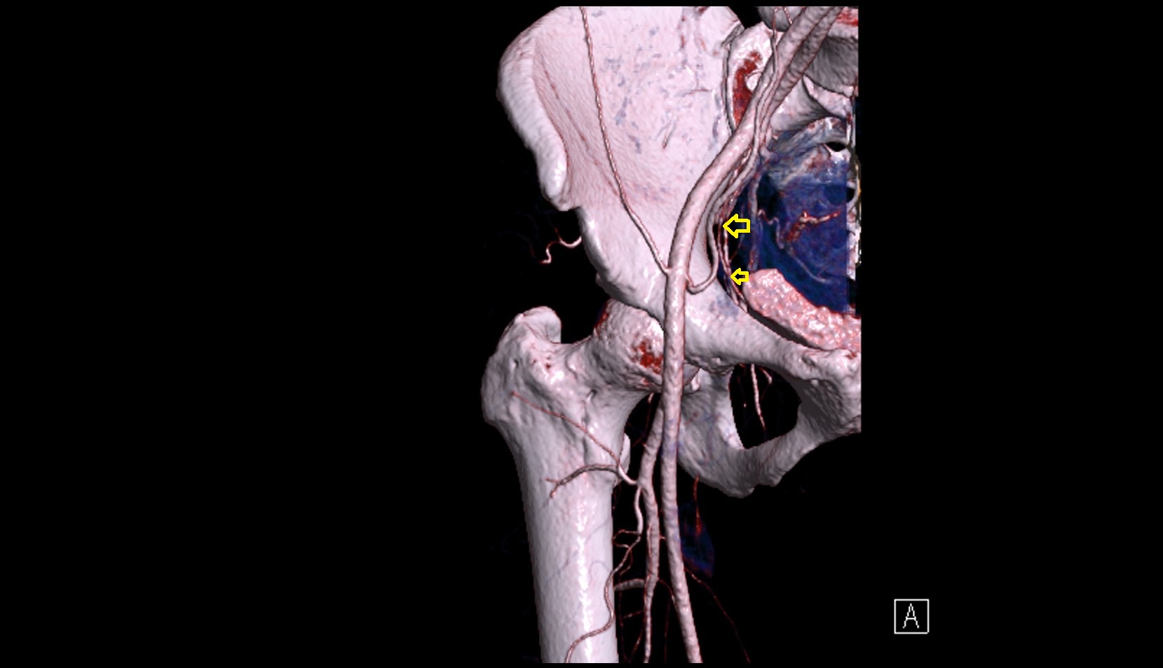 Umbilical artery  CT 3D VRT anatomy image