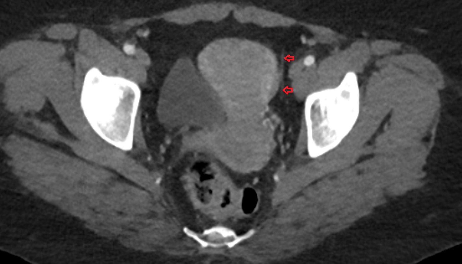 Umbilical artery  CT axial image  MRI  axial  anatomy  image-img-00000-00000