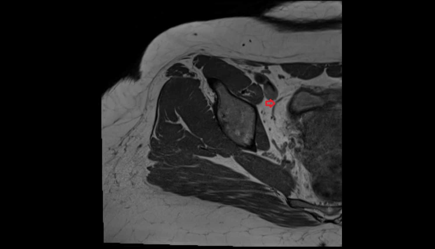 Umbilical artery  MRI axial image  MRI  axial  anatomy  image-img-00000-00000