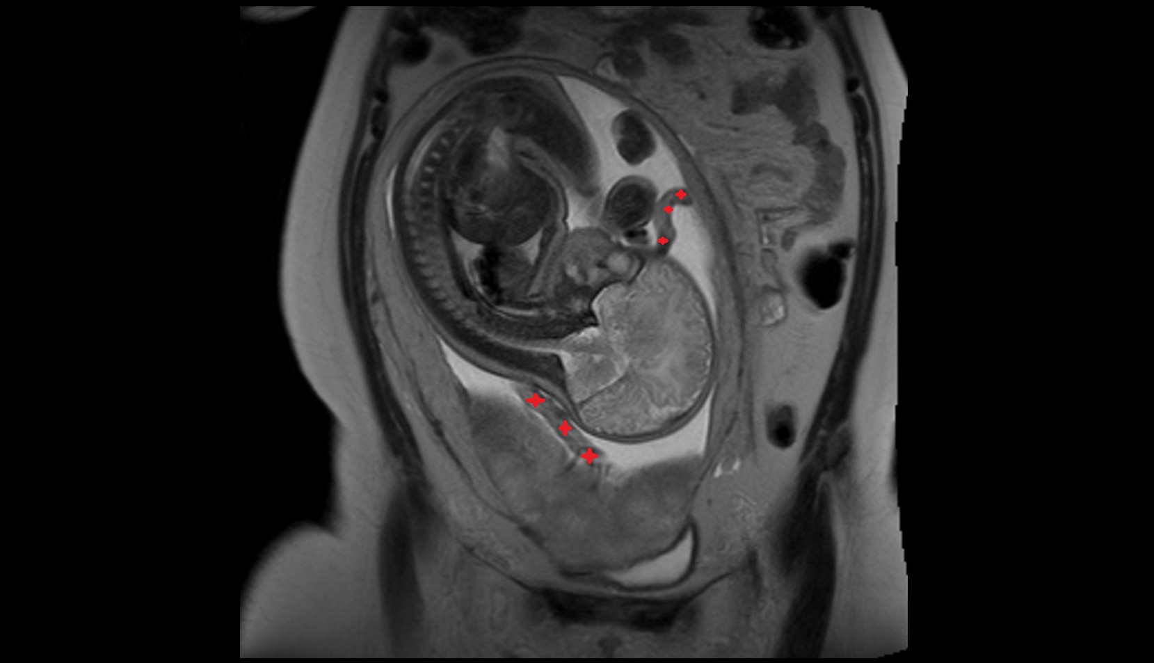 Umbilical cord mri coronal image