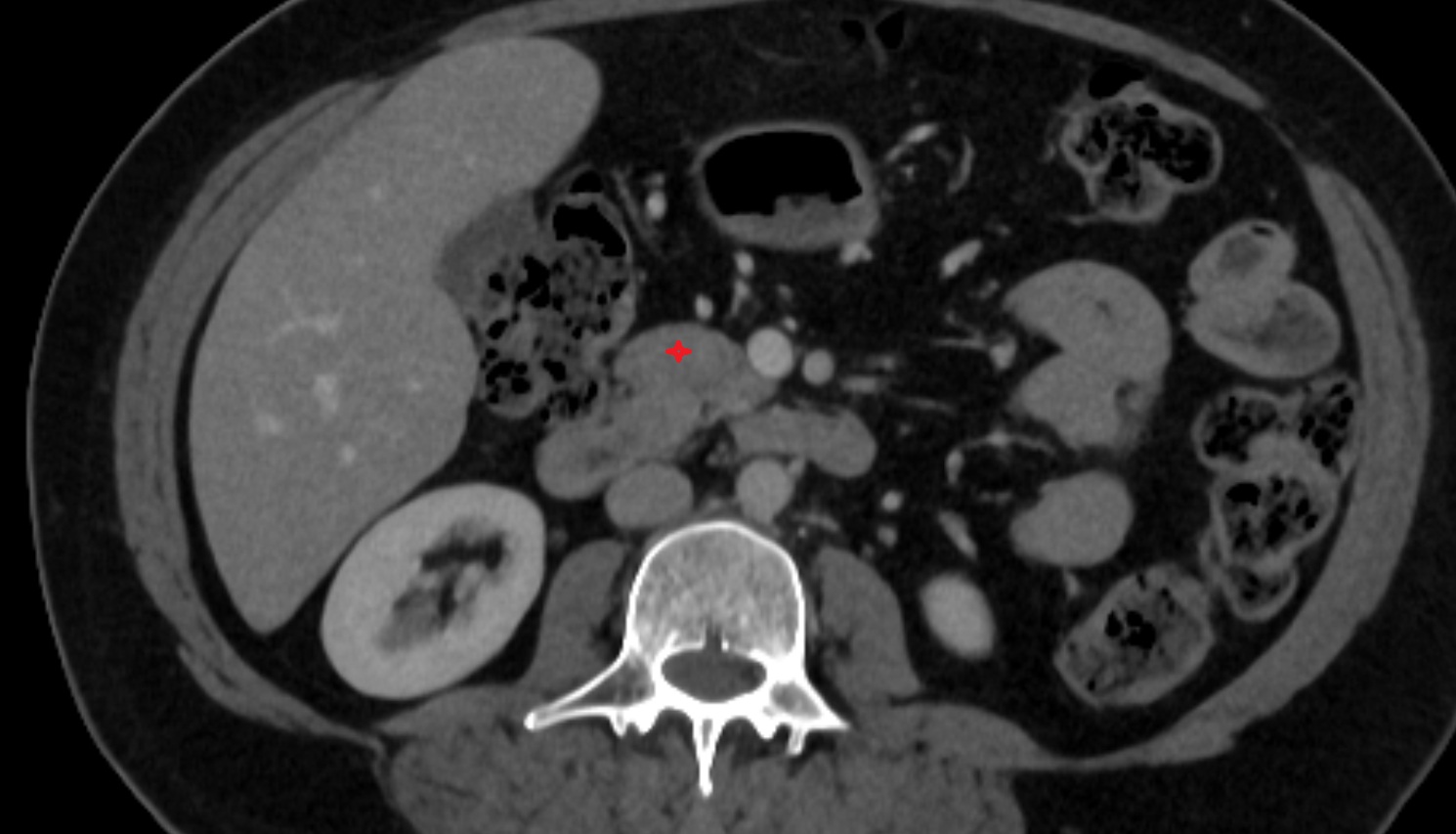 Uncinate process of pancreas  CT  axial  anatomy image-img-00000-00000