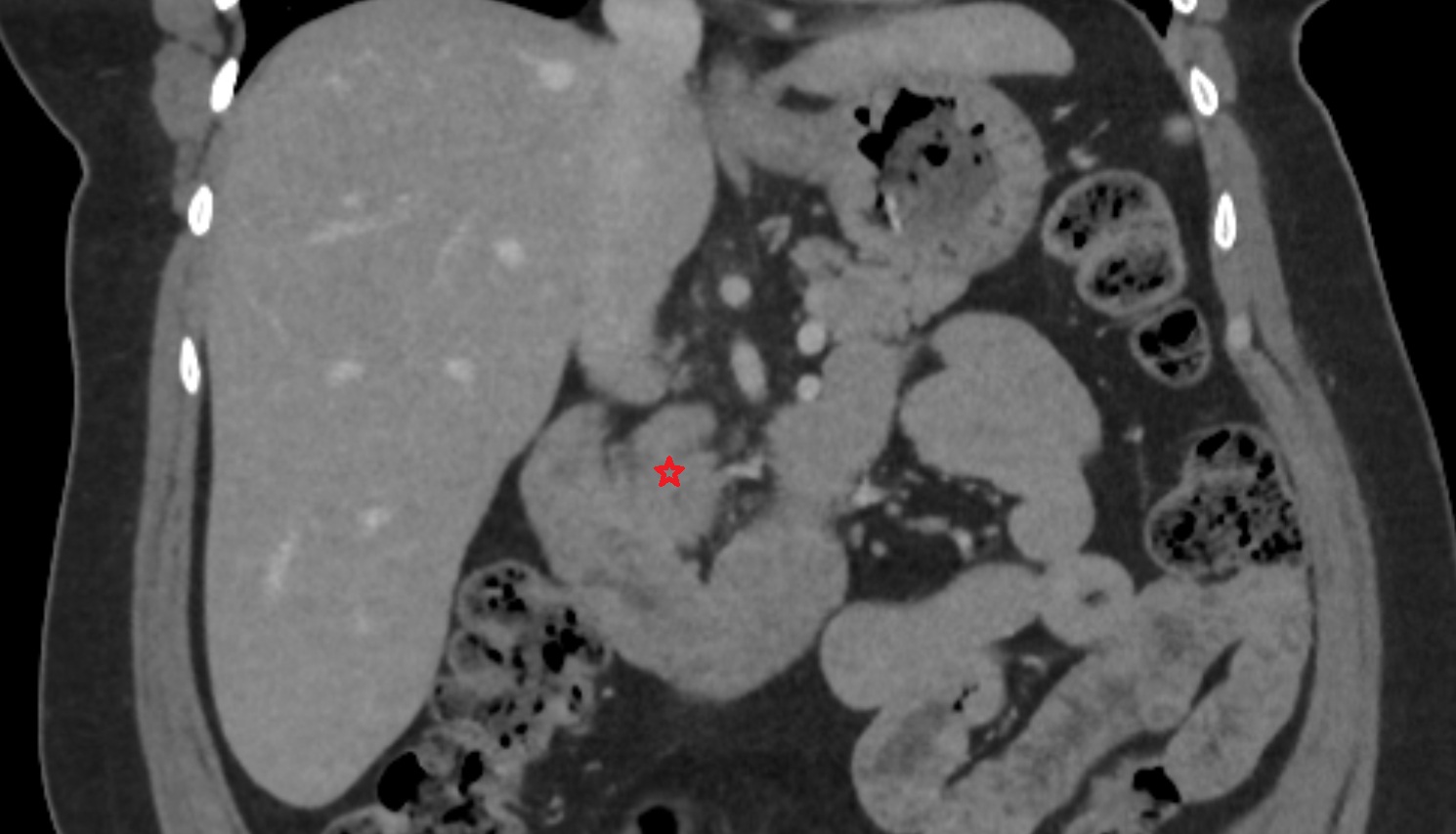 Uncinate process of pancreas  CT  coronal  anatomy image-img-00000-00000