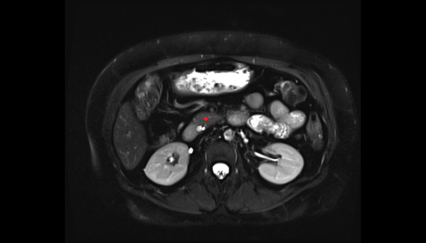 Uncinate process of pancreas  MRI axial  anatomy image-img-00000-00000