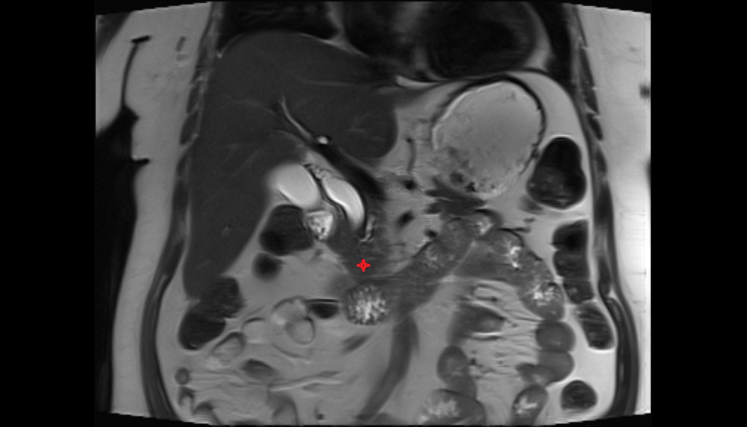 Uncinate process of pancreas  MRI coronal  anatomy image-img-00000-00000