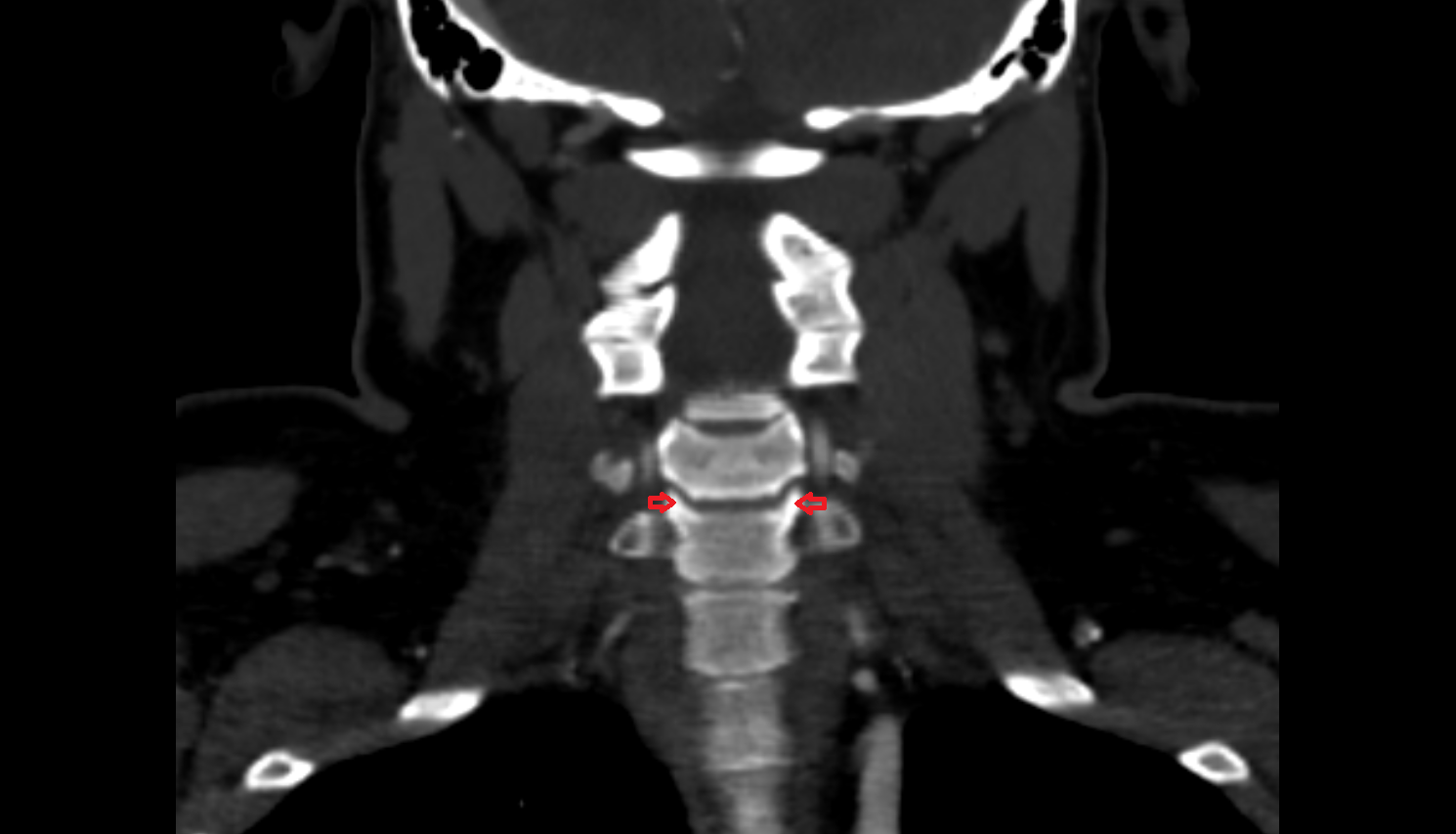 Uncinate process of vertebra of  vertebra , Location and Imaging Appearance  -img-00000-00000