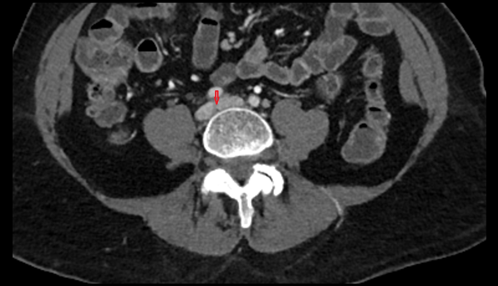Union of common iliac veins CT axial