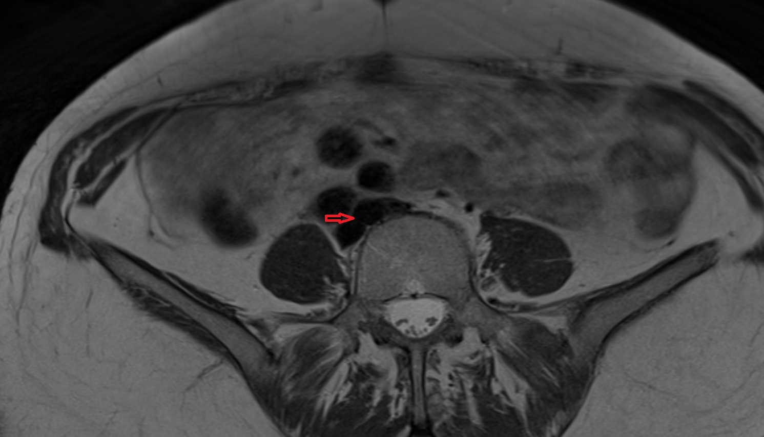 Union of common iliac veins   MRI  axial  anatomy  image-img-00000-00000
