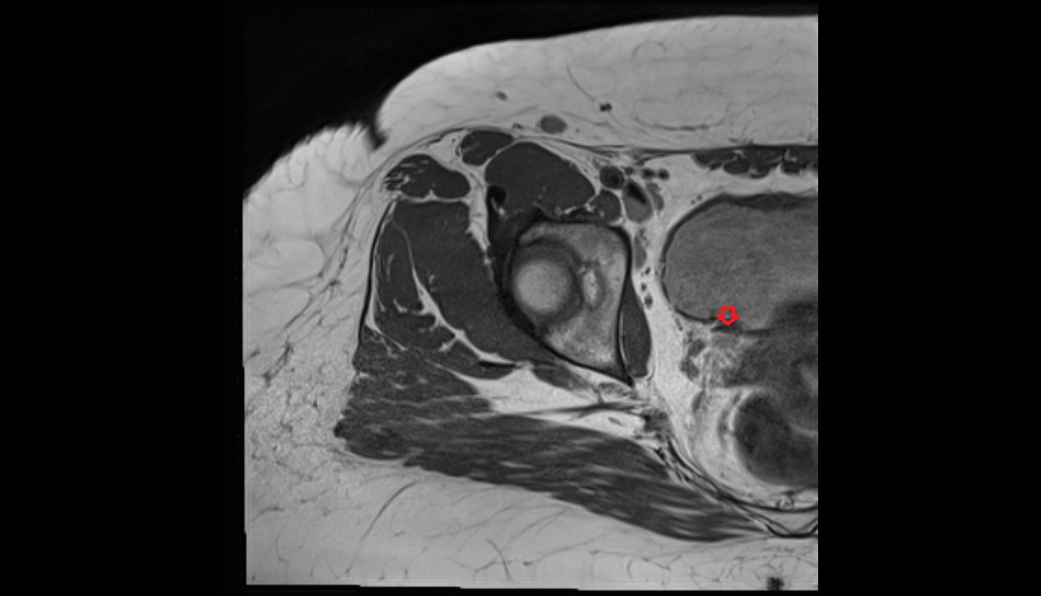 Ureter  MRI pelvis axial anatomy image-img-00000-00000