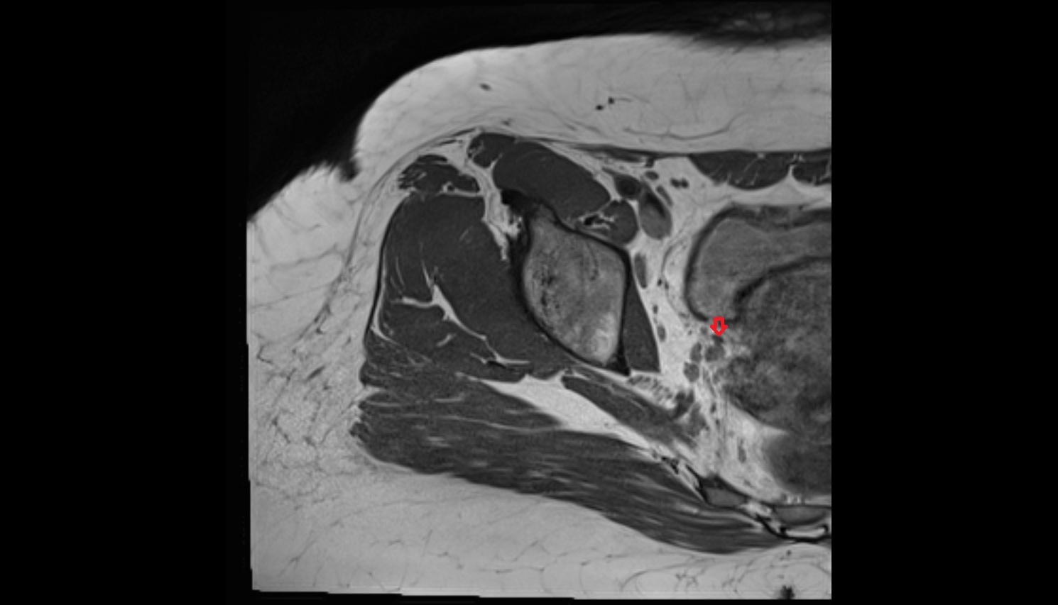 Ureter  MRI pelvis axial anatomy image-img-00000-00000_00001