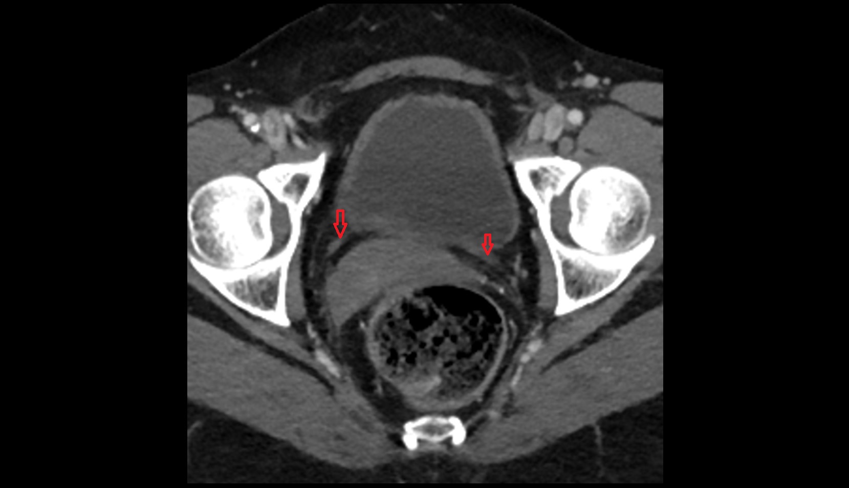 Ureter ct pelvis image