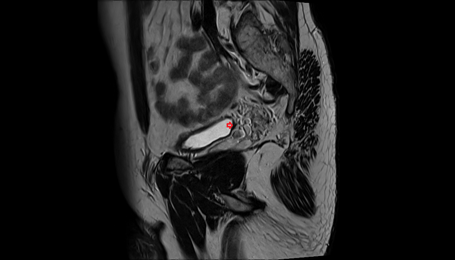 Ureteric Orifice MRI sag image-img-00000-00000