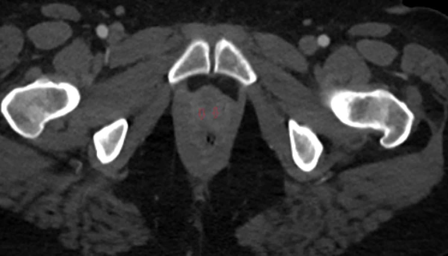 Urethrovaginal space  ct  axial anatomy  image-img-00000-00000