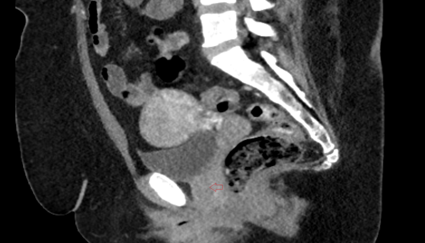 Urethrovaginal space  ct  sag anatomy  image-img-00000-00000