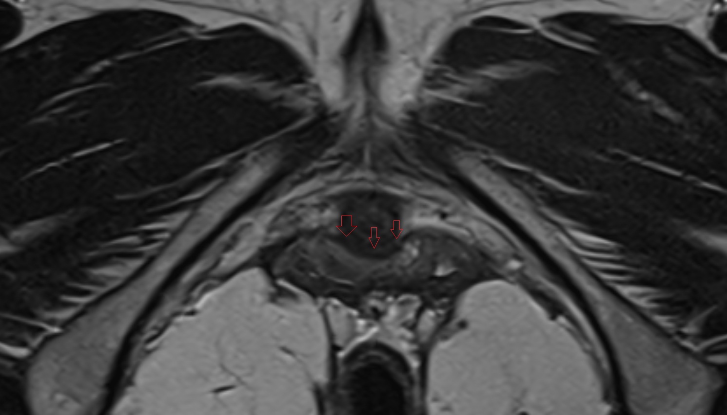 Urethrovaginal space  mri  axial  anatomy  image-img-00000-00000