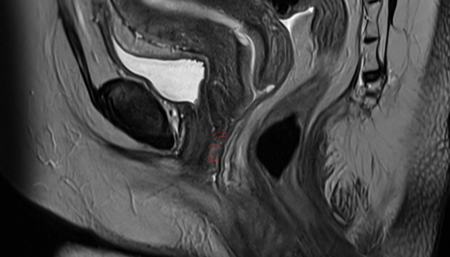 Urethrovaginal space  mri  sag anatomy  image-img-00000-00000