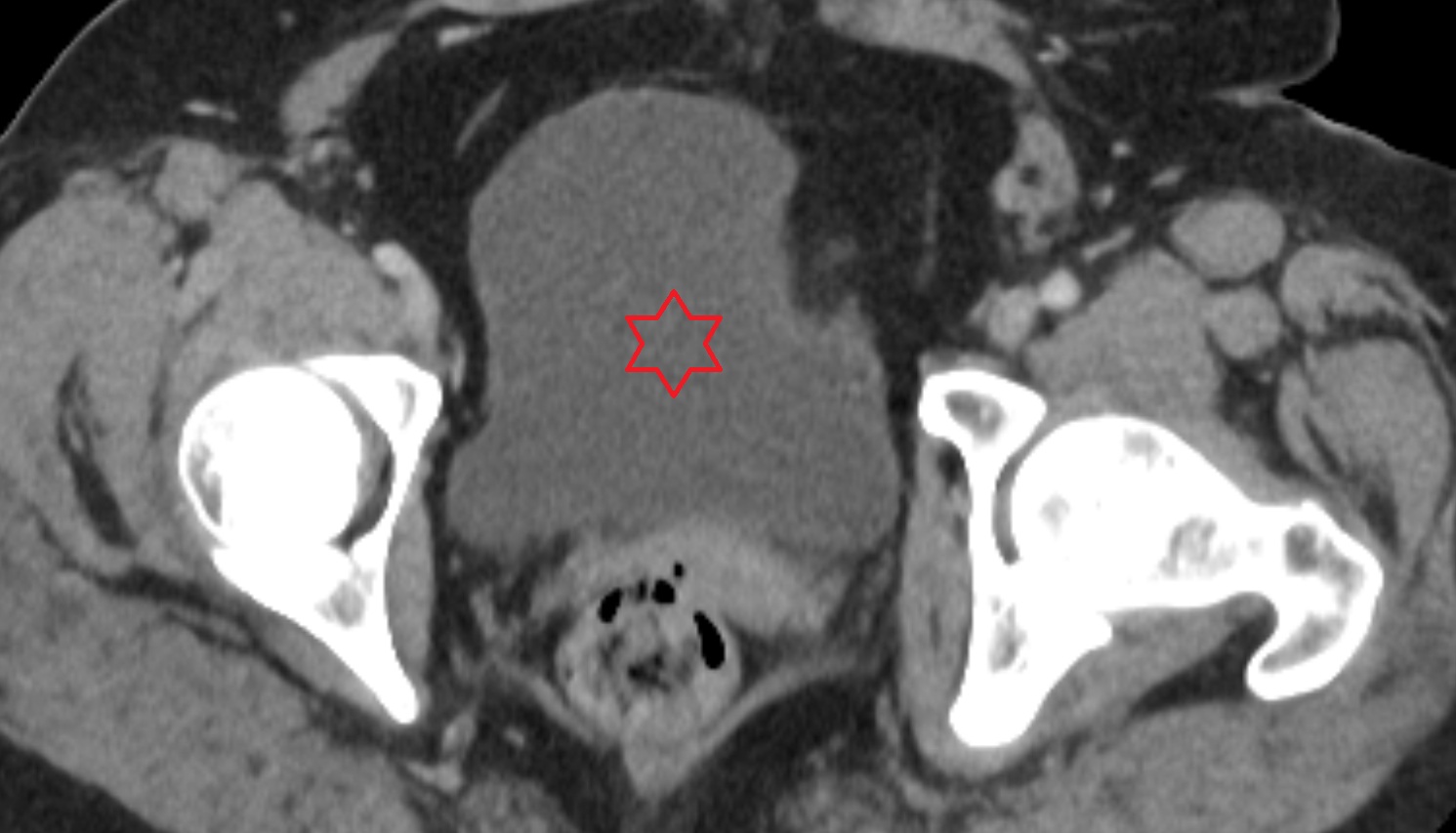 Urinary bladder  female  CT axial anatomy  image-img-00000-00000