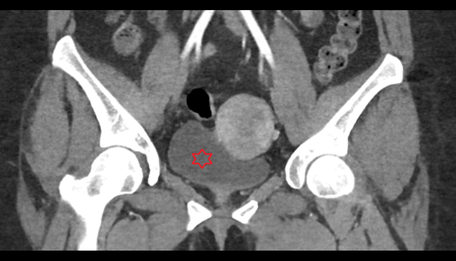 Urinary bladder female CT coronal  anatomy  image-img-00000-00000
