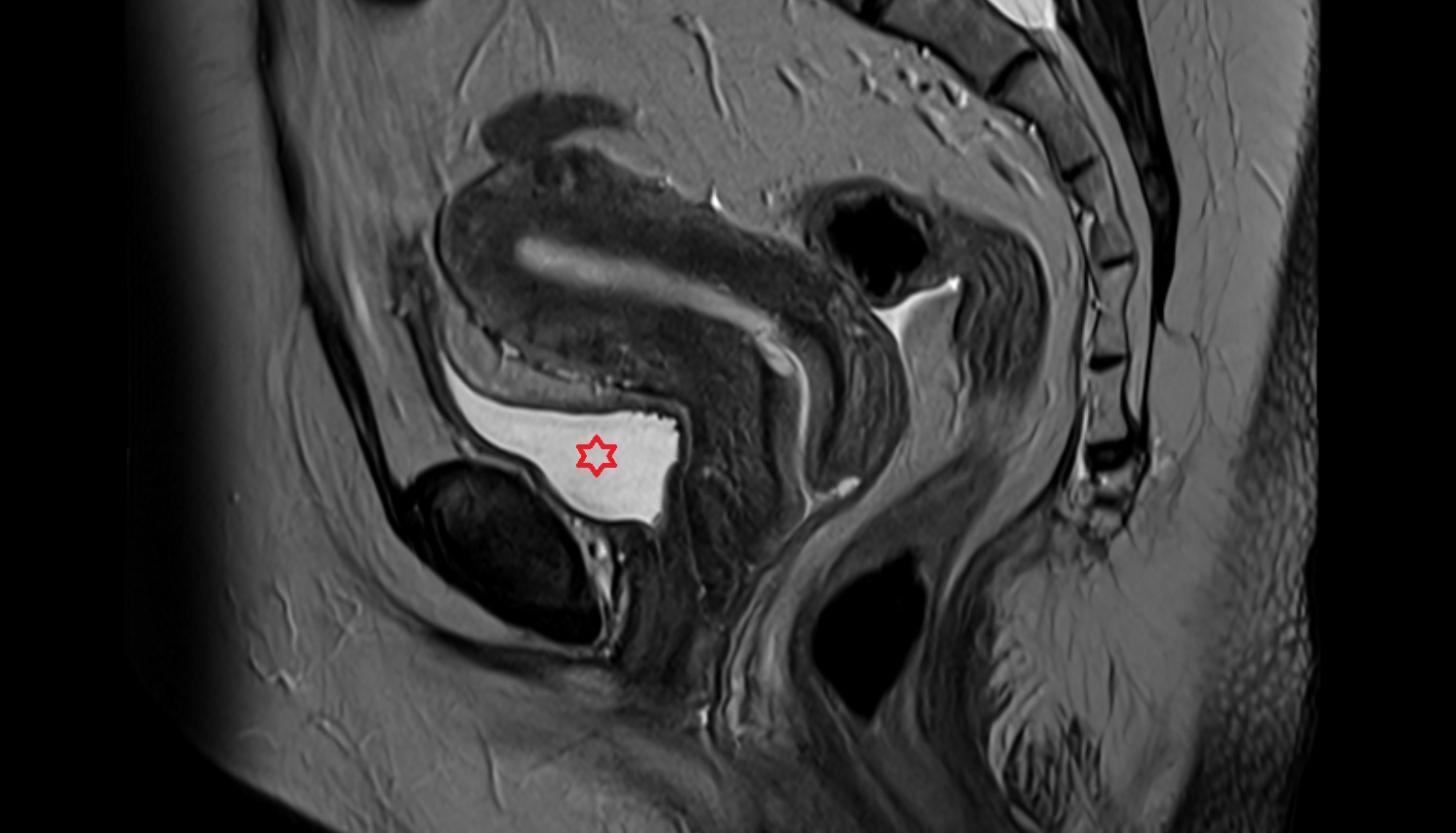 Urinary bladder female mri sagital image anatomy  image-img-00000-00000