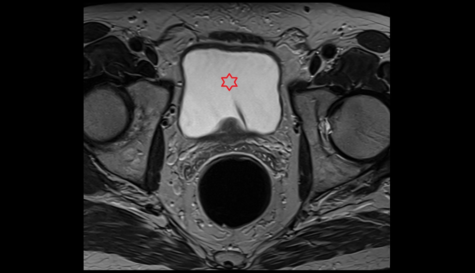 Urinary bladder mri male pelvis  axial