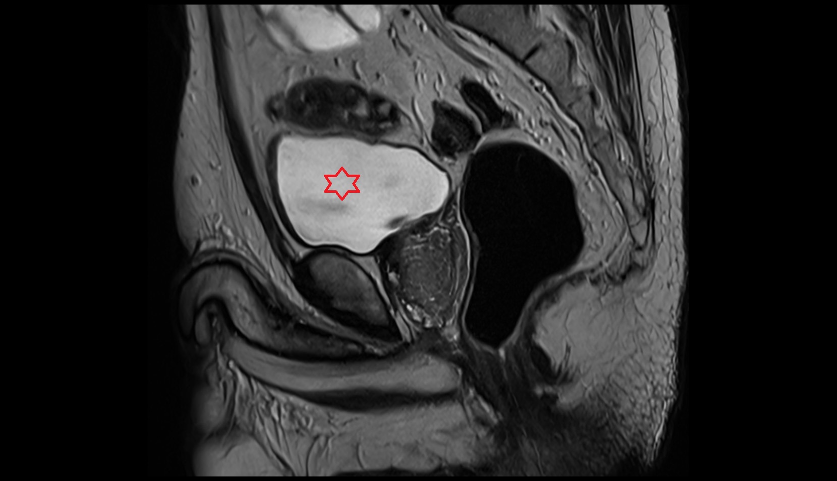 Urinary bladder mri male pelvis sagittal