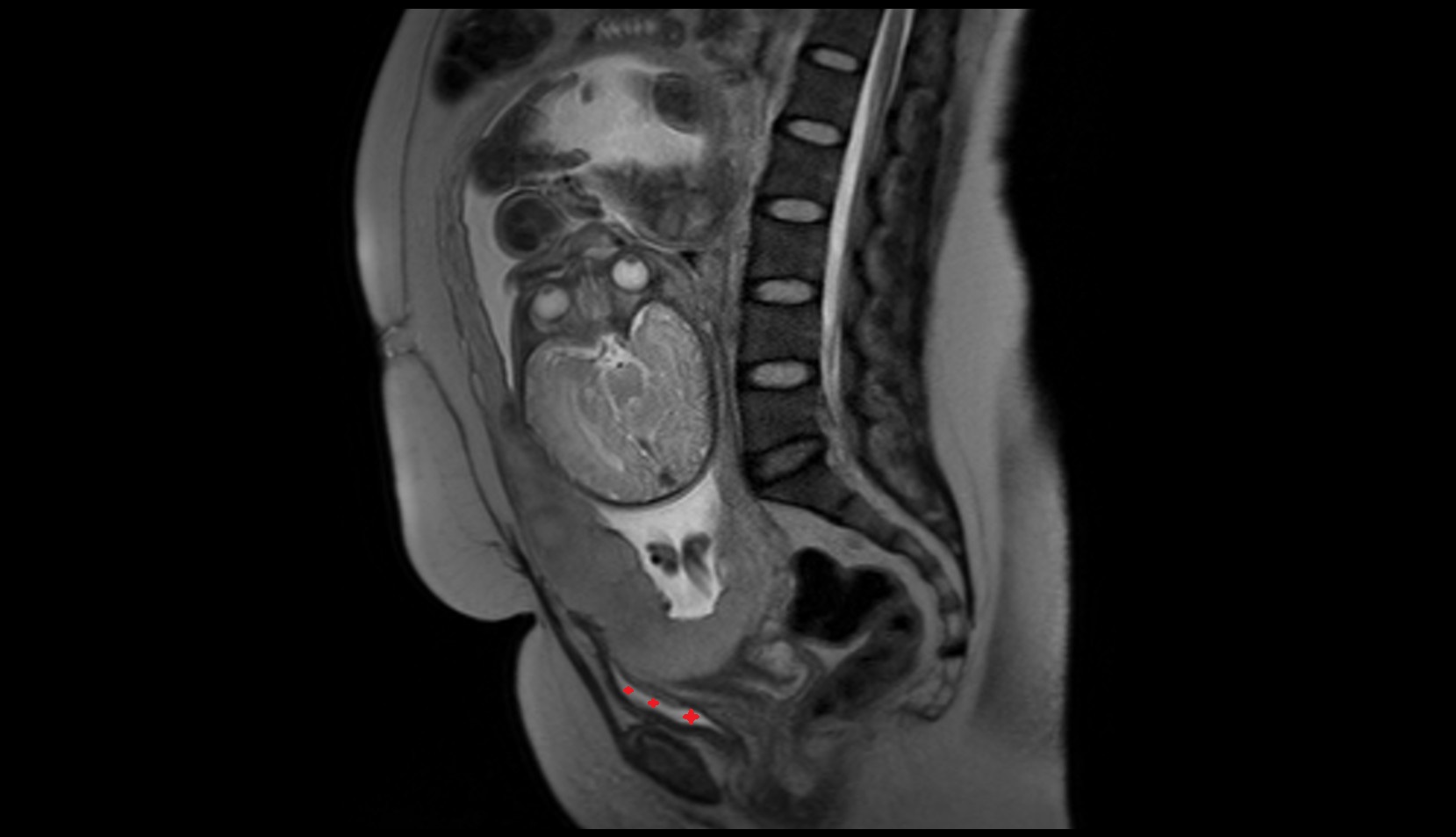 Urinary bladder  (pregnancy) mri sagittal image