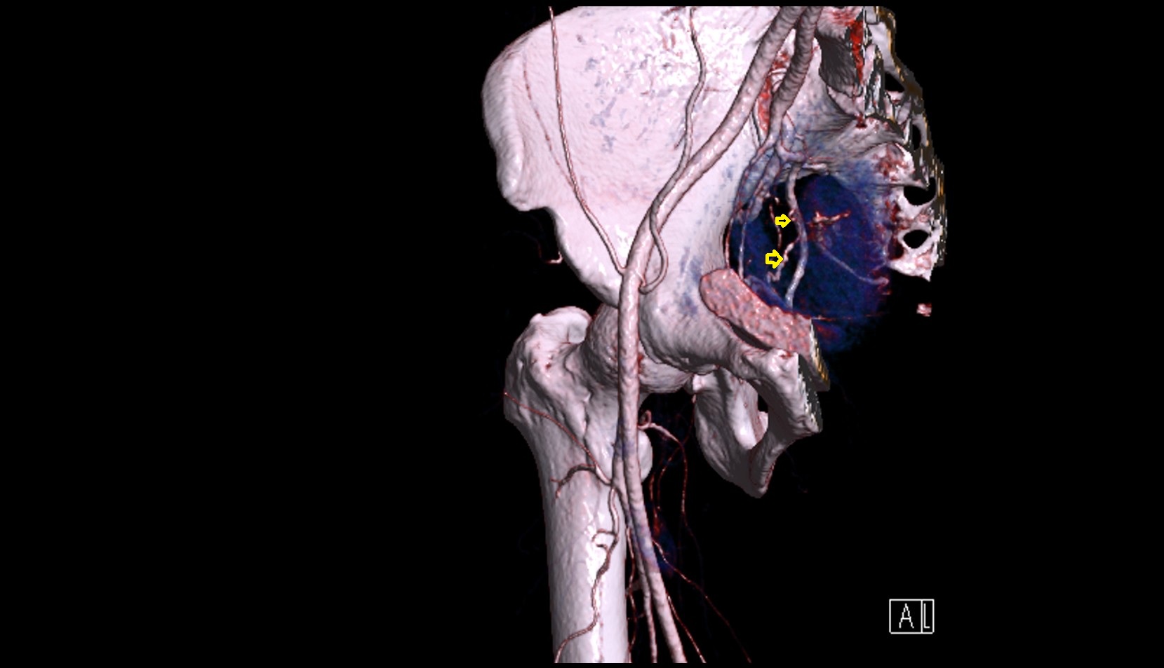 Uterine artery  CT 3D VRT anatomy image