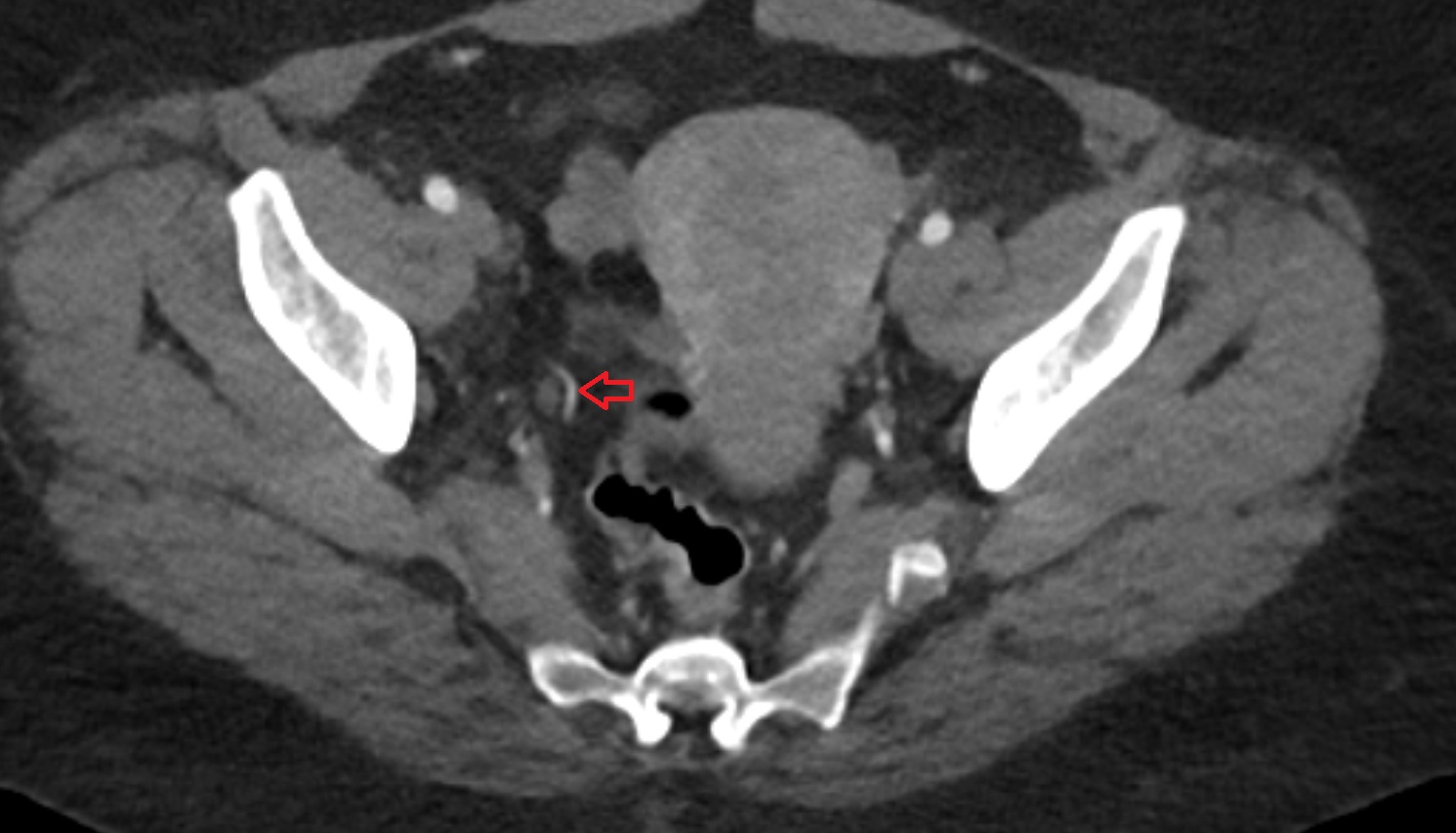 Uterine artery  CT axial image  MRI  axial  anatomy  image-img-00000-00000