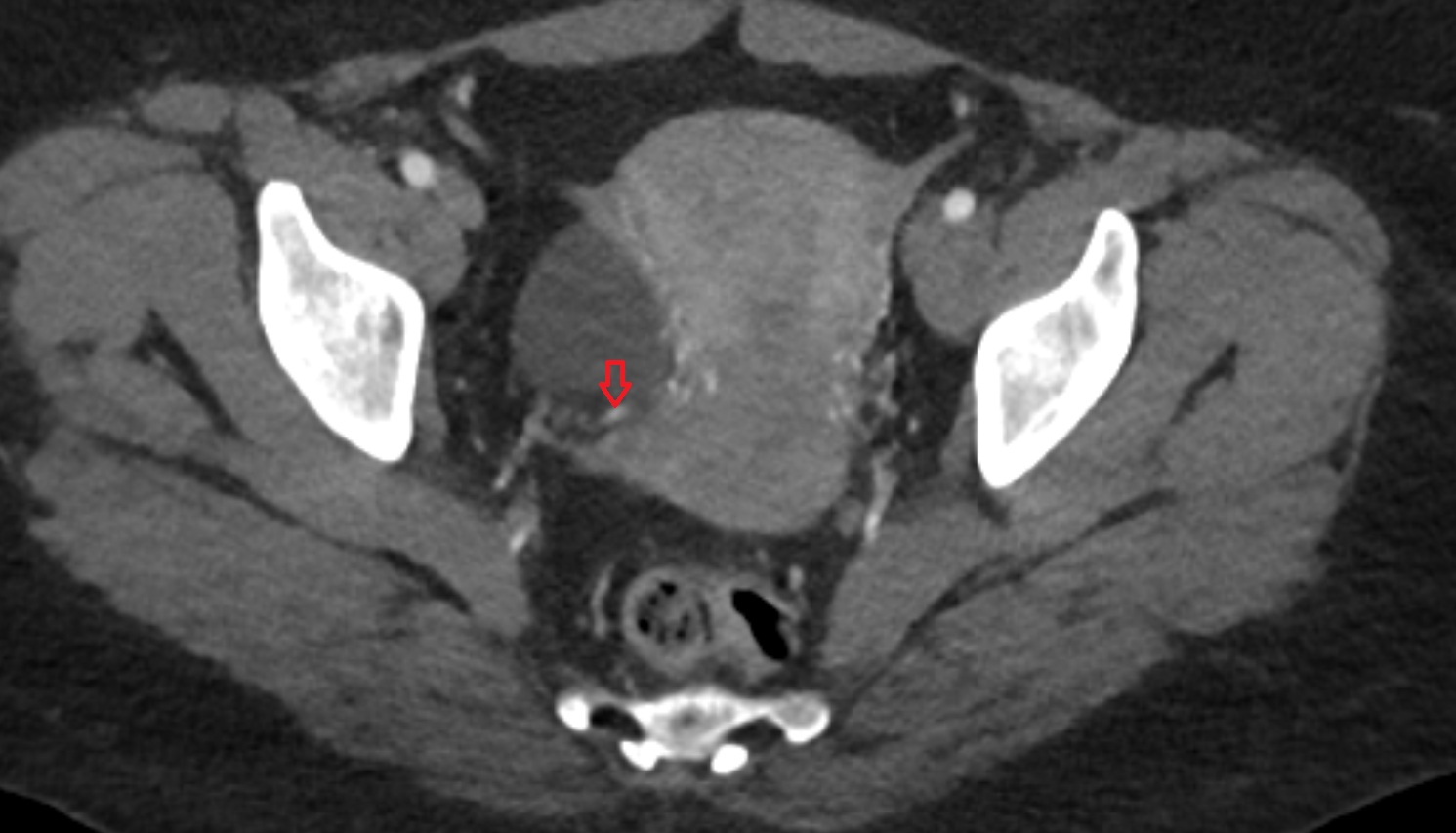 Uterine artery  CT axial image  MRI  axial  anatomy  image-img-00000-00000_00001