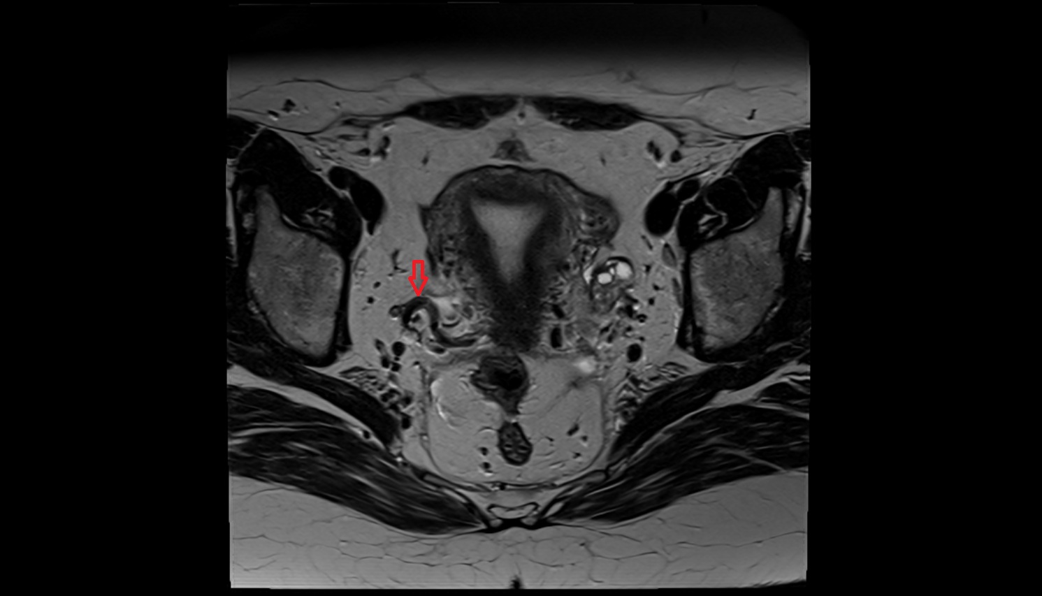 Uterine artery  MRI axial image  MRI  axial  anatomy  image-img-00000-00000
