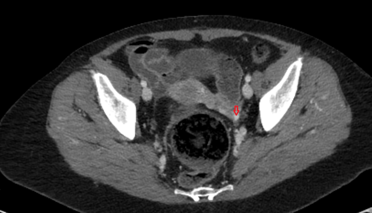Uterine veins  ct  axial  anatomy  image-img-00000-00000