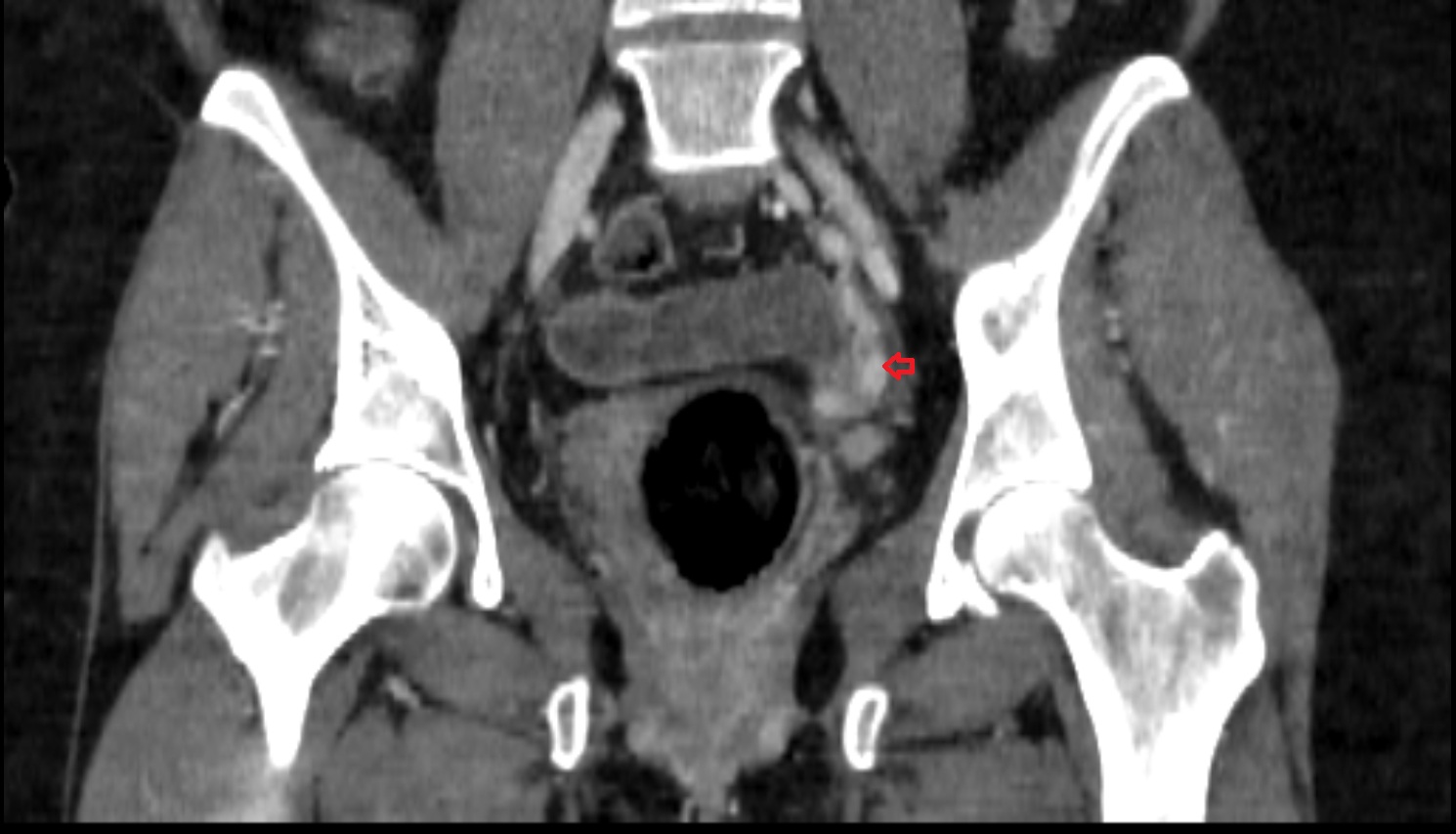 Uterine veins  ct coronal  anatomy  image-img-00000-00000