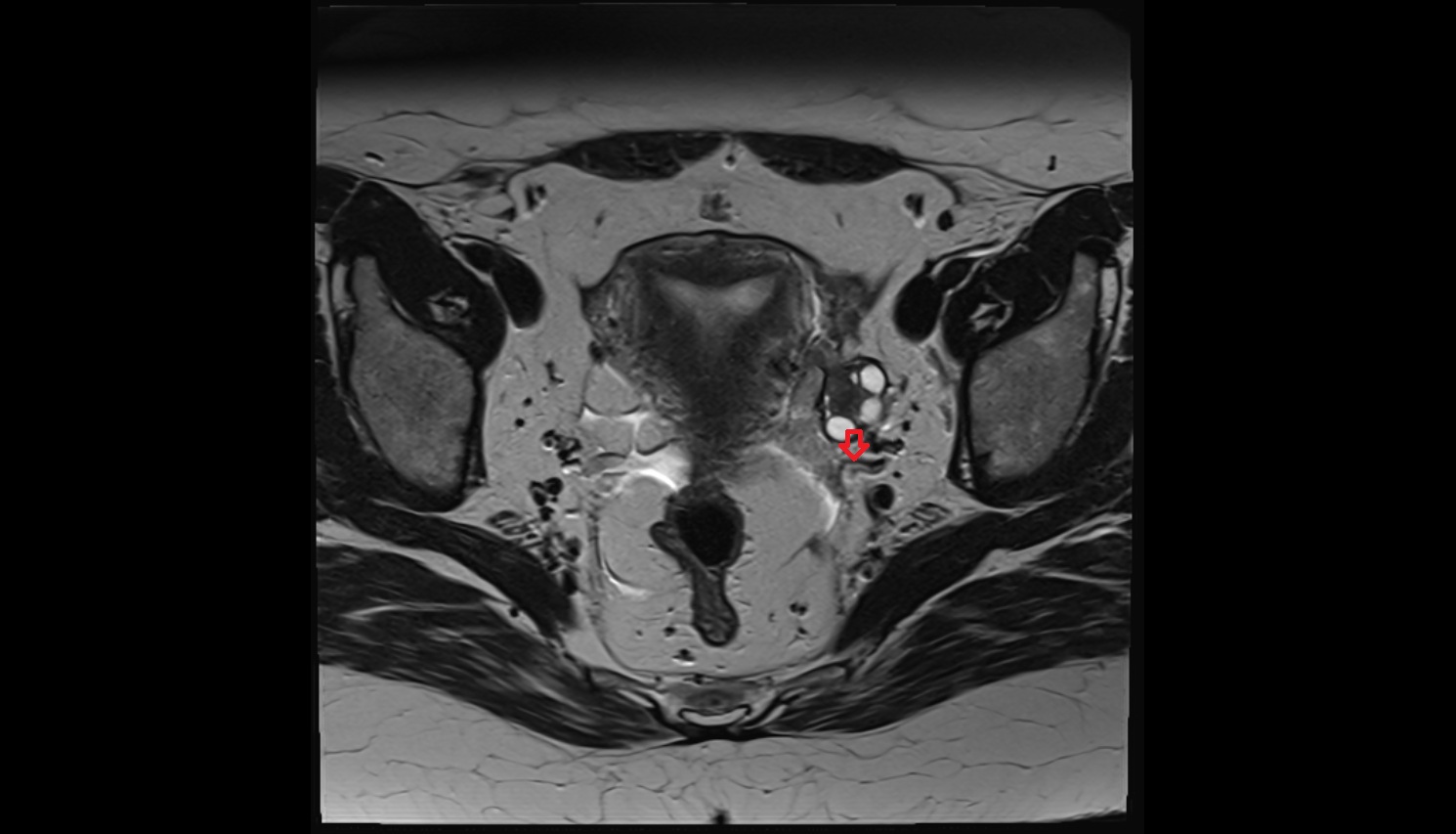 Uterine veins  mri axial  anatomy  image-img-00000-00000