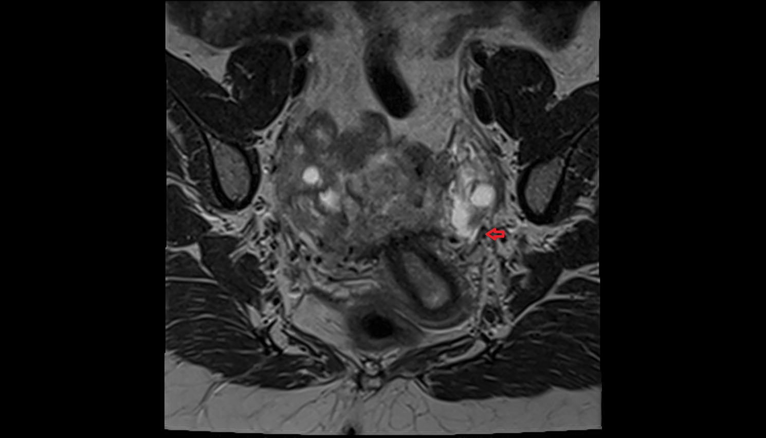 Uterine veins  mri coronal  anatomy  image-img-00000-00000