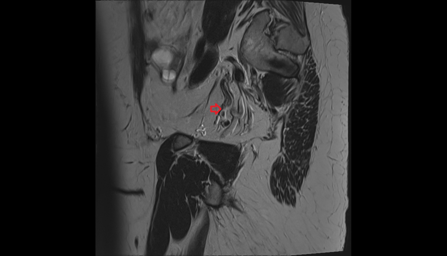 Uterine veins  mri sagital  anatomy  image-img-00000-00000