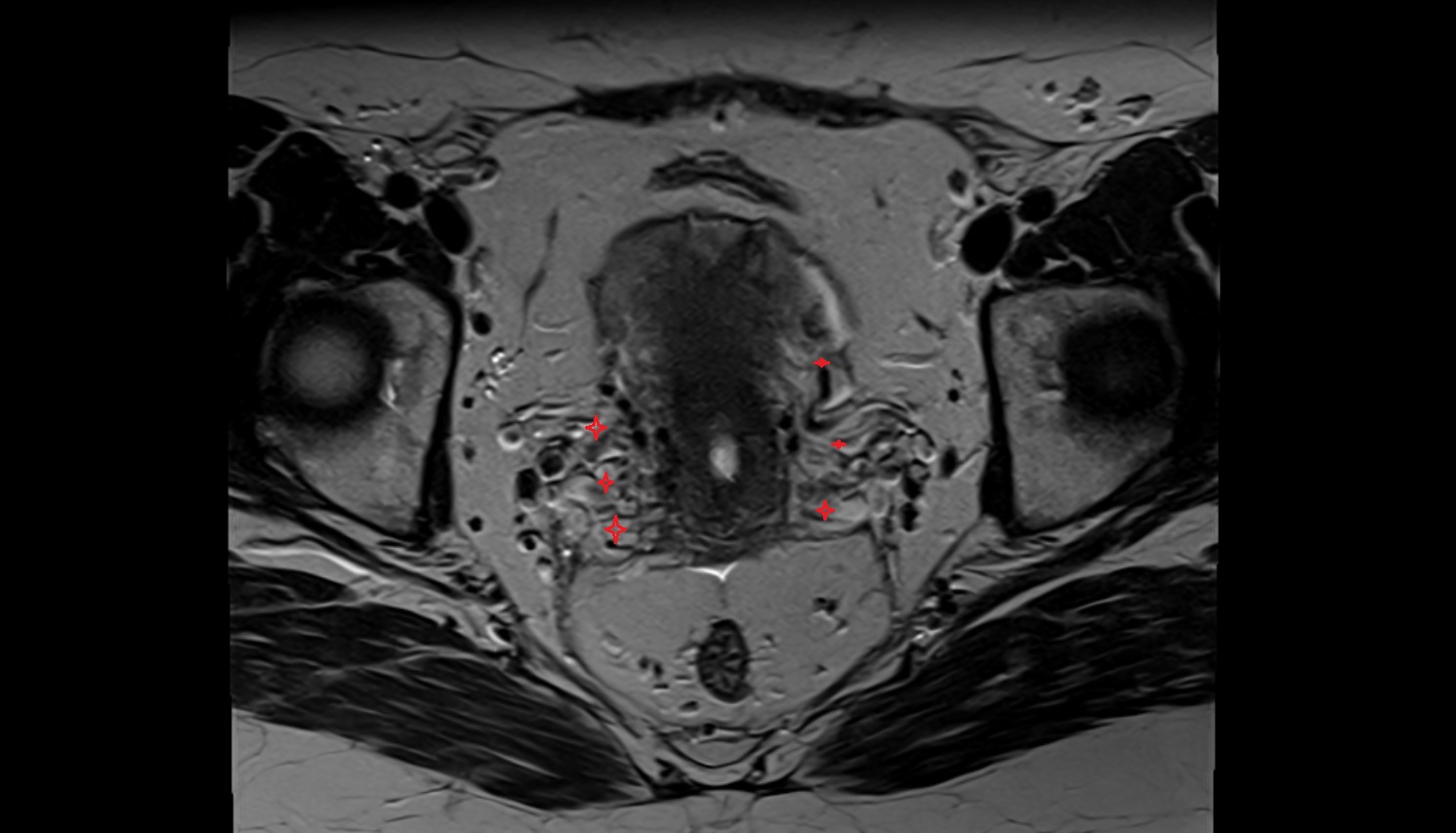 Uterine venous plexus  MRI  axial  anatomy  image-img-00000-00000