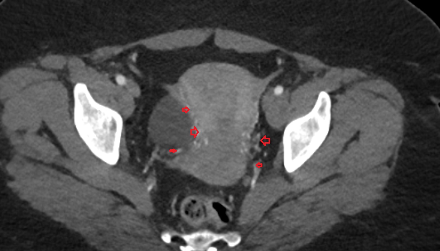 Uterine venous plexus  ct  axial  anatomy  image-img-00000-00000