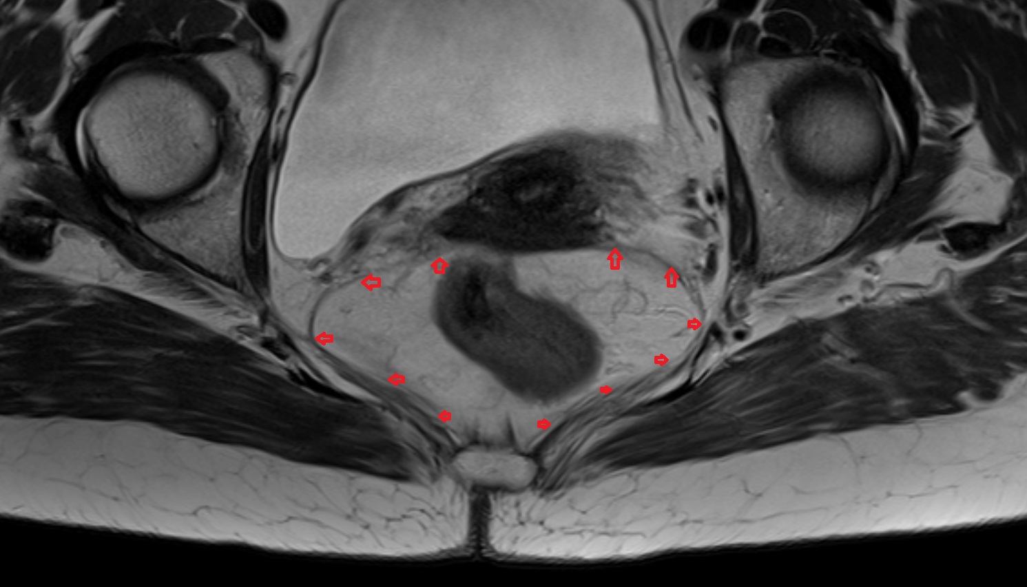 Uterosacral ligament  MRI  axial  anatomy  image-img-00000-00000