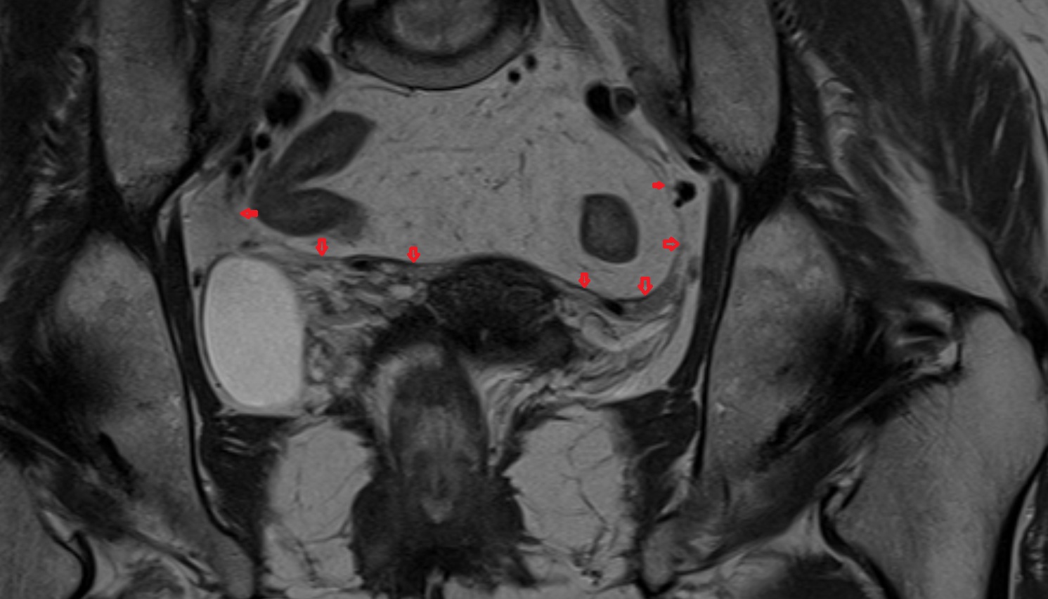 Uterosacral ligament  MRI  coronal  anatomy  image-img-00000-00000