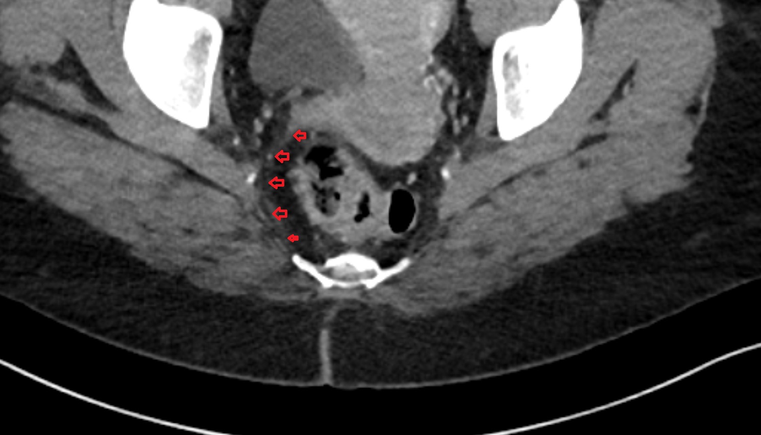 Uterosacral ligament  ct  axial  anatomy  image-img-00000-00000