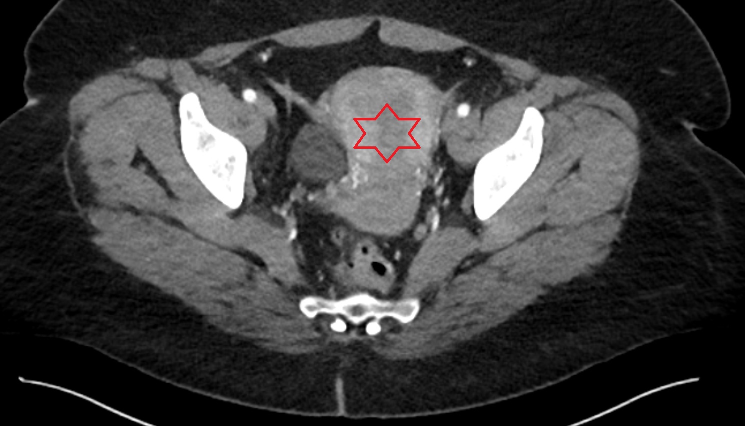 Uterus CT axial  image anatomy  image-img-00000-00000