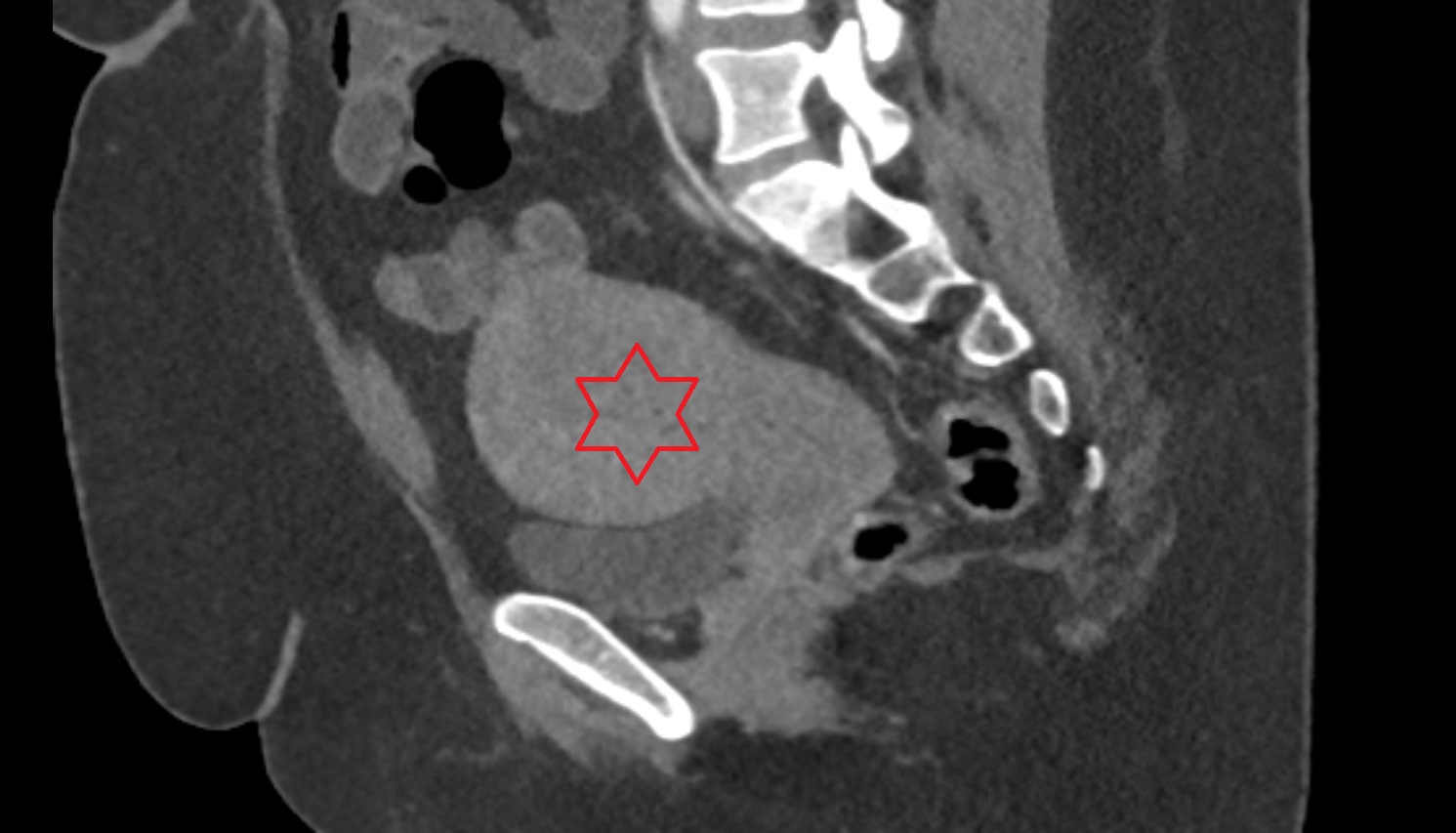 Uterus CT sagittal  image anatomy  image-img-00000-00000