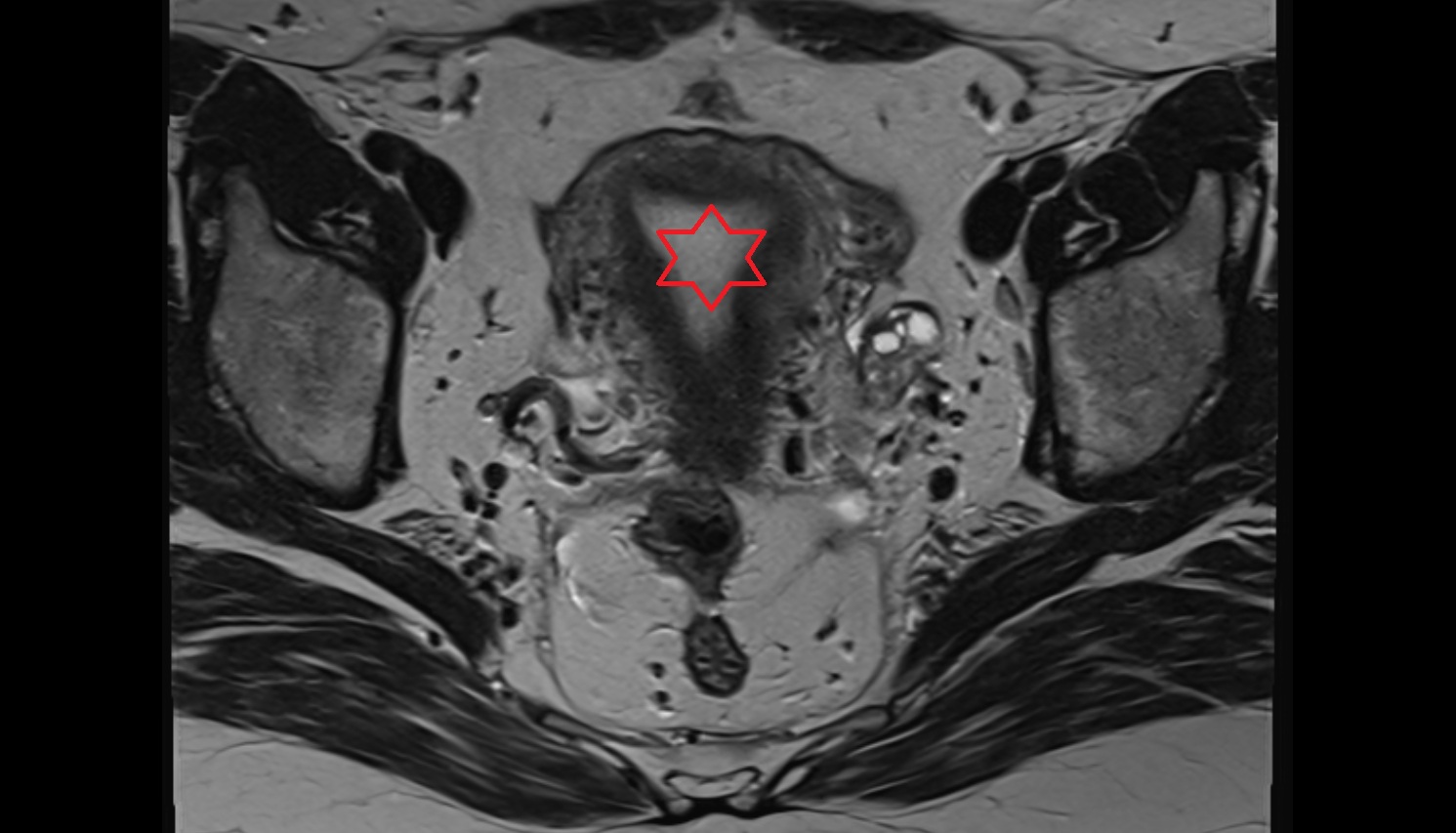 Uterus MRI axial  image anatomy  image-img-00000-00000