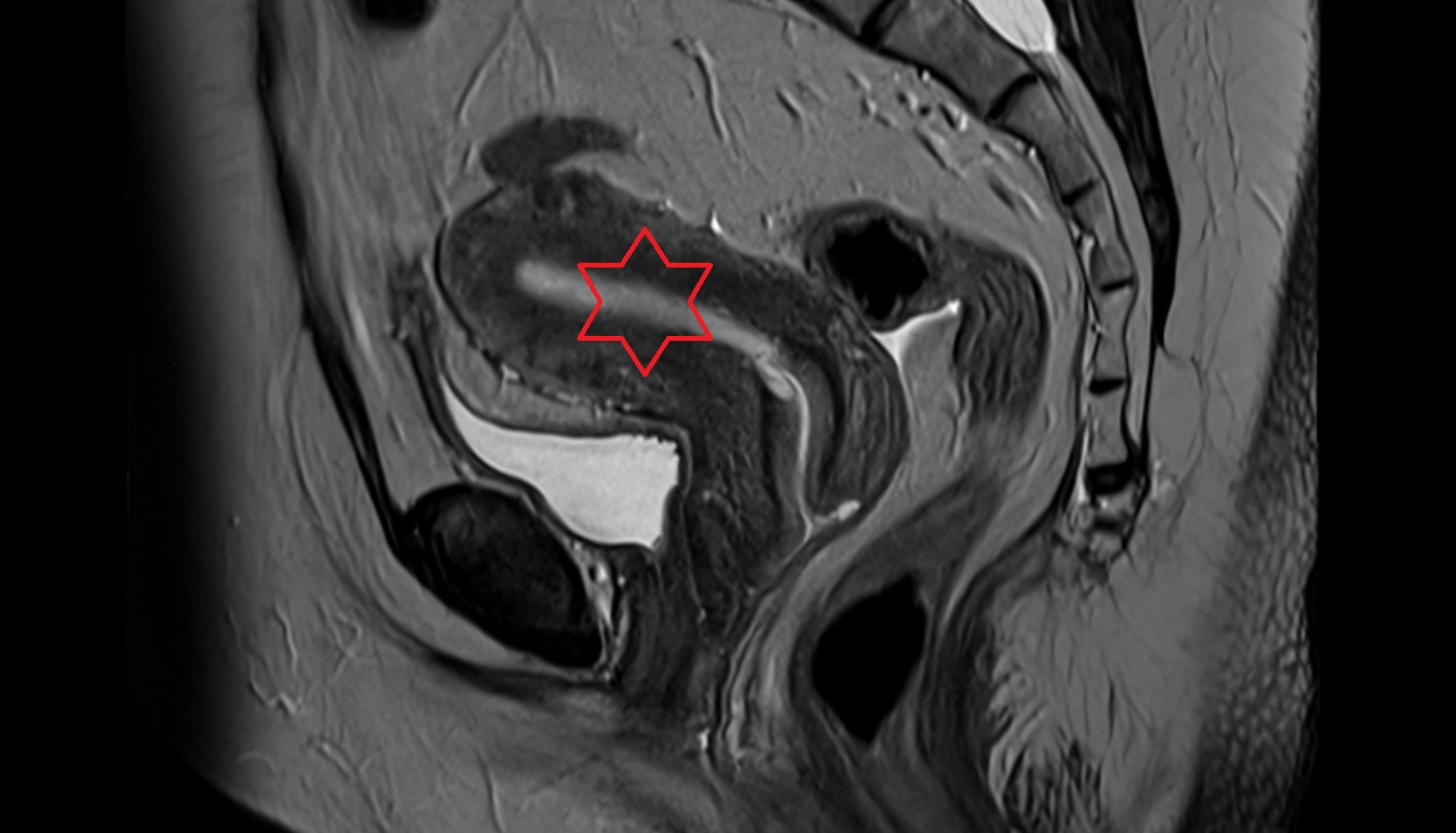 Uterus MRI sagittal  image anatomy  image-img-00000-00000