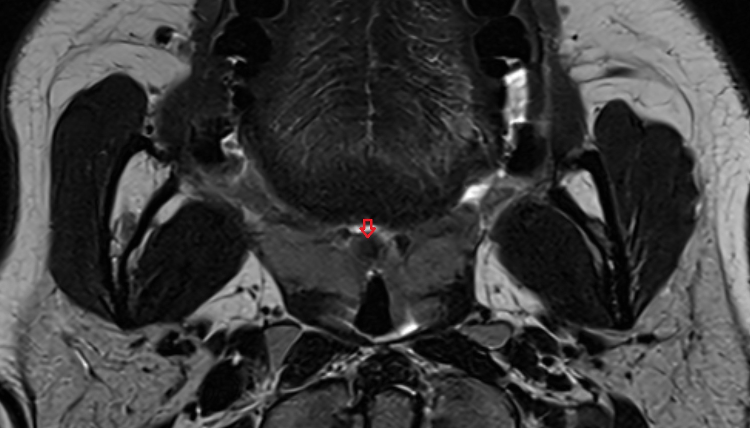 Uvula of palate mri axial image -img-00000-00000